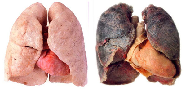 Pulmones sanos y pulmones de un fumador
